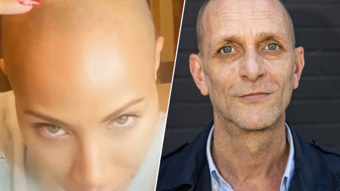 Onze reporter heeft dezelfde aandoening als Jada Pinkett-Smith: “Kan me voorstellen dat zo'n grap bij sommige mensen echt pijn doet"
