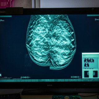 Drie ‘te dure’ medicijnen tegen onder meer borst­kanker voorlopig niet vergoed in basispakket