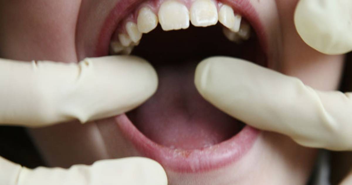 Tandartsen vullen onnodig veel gaatjes bij kleine kinderen Gezond AD.nl