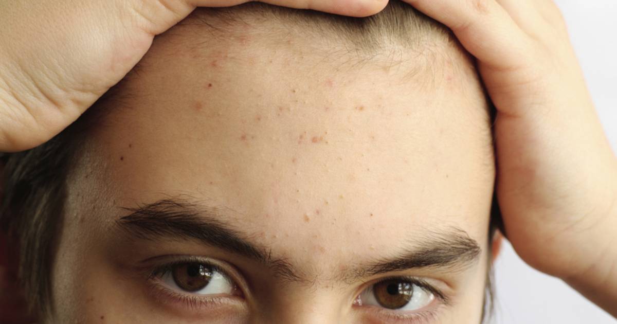 Почему лоб чернее. Закрытые комедоны на лице. Женские стрижки с залысинами. Почему лоб чернее. Закрытые комендант на лице.