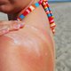 Burn baby, burn: hoe gevaarlijk is één keer verbranden nu echt?