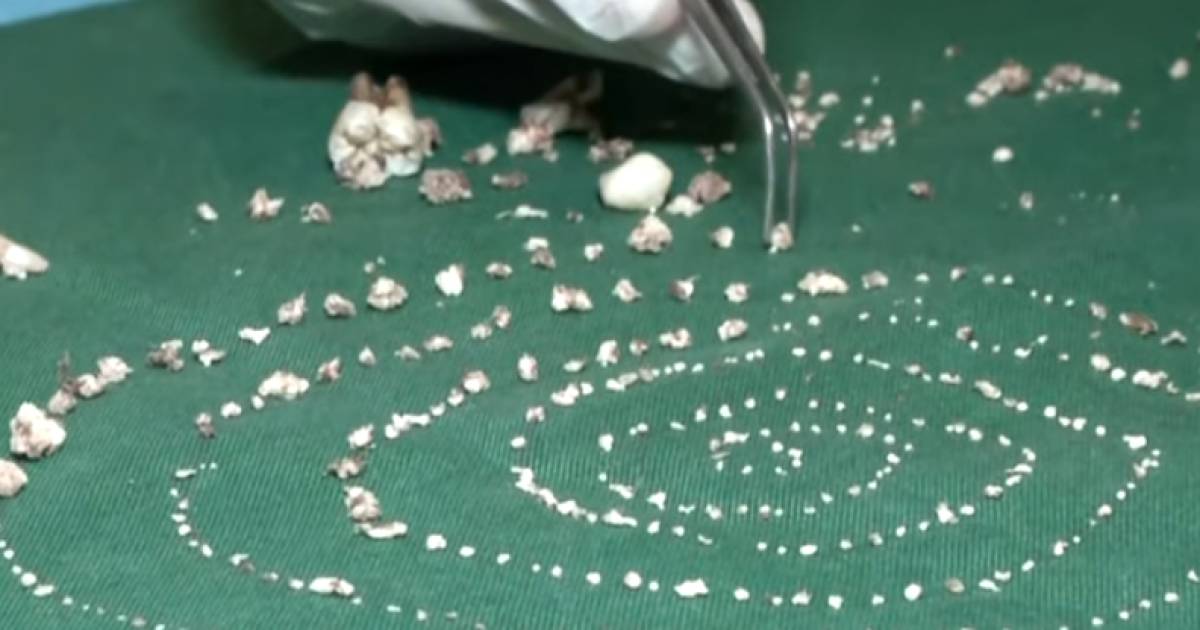 Kaakchirurg Verwijdert 526 Tandjes Uit Gezwel In Mond 7 Jarige Indiase Jongen Bizar Ad Nl