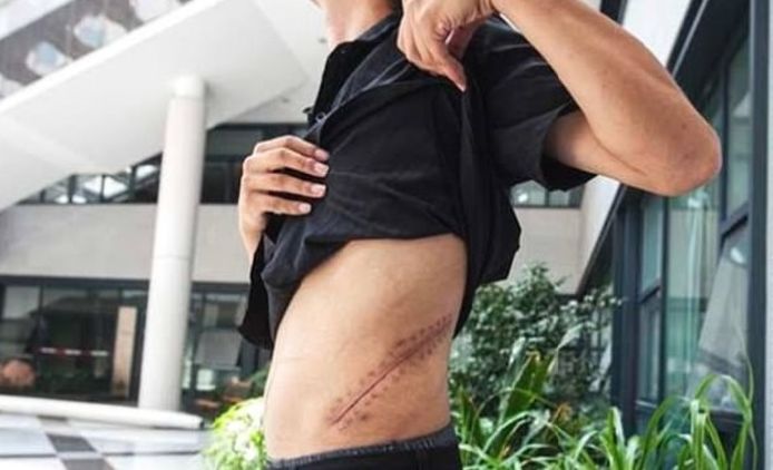 Het litteken dat Wang overhield aan de operatie.