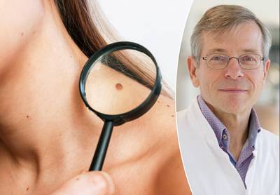 This is how you recognize a melanoma in time: “There was a strange birthmark on my calf, it turned out to be wrong”