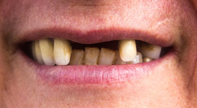 Vrouw ontslagen omwille van afgebroken tanden: wat zijn je redenen bij een onredelijk ontslag? En op welke vergoedingen heb je recht?