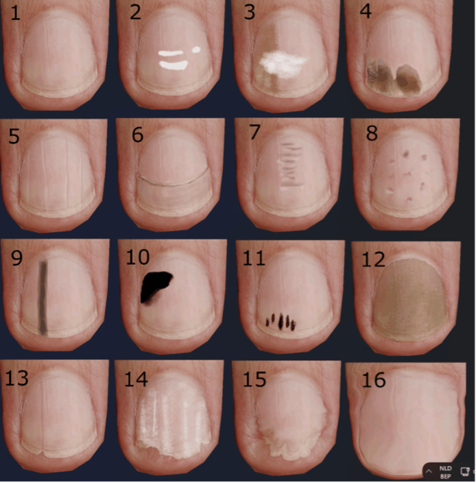 Ce que les taches et fissures sur vos ongles révèlent de votre santé Santé & bienêtre 7sur7.be