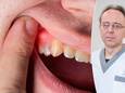 Parodontoloog Wim Teughels van het UZ Leuven doet tandvleescorrecties: "Normaal tandvlees is 2 tot 3 millimeter hoog."