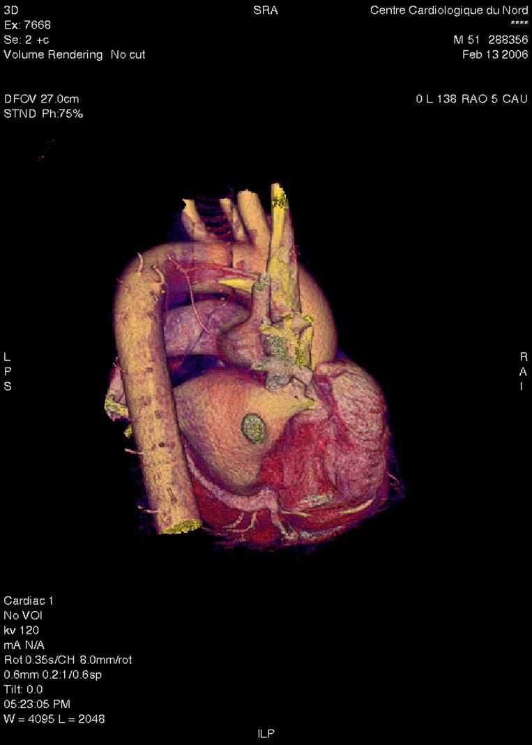 Een 3D-scan van een hart. Beeld Universal Images Group via Getty