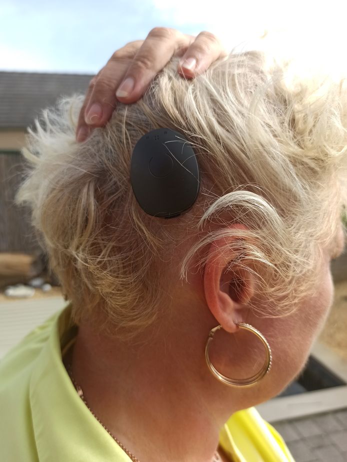 Het cochleair implantaat bestaat uit een inwendig en uitwendig gedeelte. Het inwendig gedeelte zit in de schedel en maakt verbinding met het uitwendig gedeelte.
