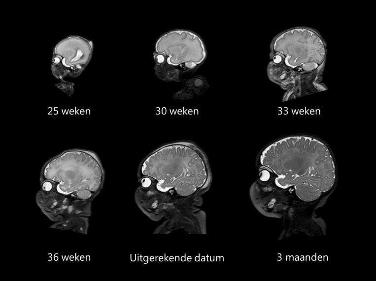 Hersenontwikkeling: van een foetus tot een baby van drie maanden.  Beeld Nathalie Claessens / UMC Utrecht 