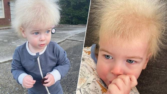 “Ik dacht eerst dat er iets mis was”: moeder deelt foto’s van zoontje met onhandelbaar haarsyndroom