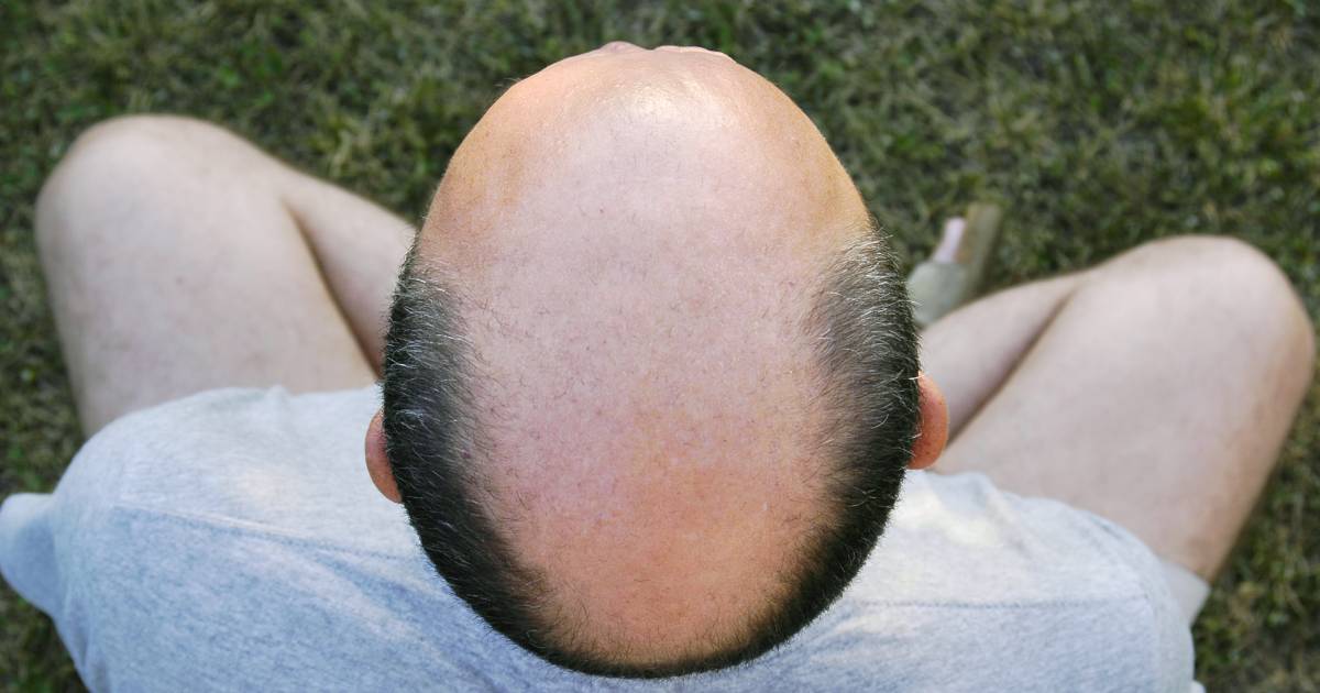 Speranza per la calvizie negli uomini (e nelle donne): un nuovo studio potrebbe essere la prima svolta verso una cura |  sano e felice