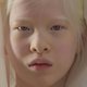 Dit albinomeisje werd te vondeling gelegd en is nu model mét belangrijke boodschap