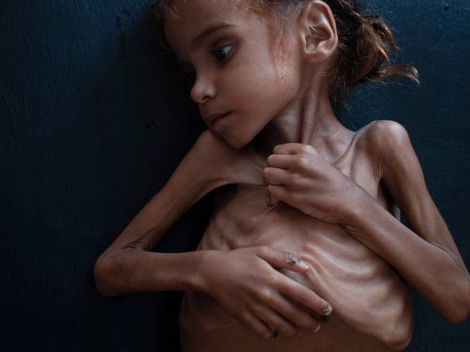 Uitgemergeld Jemenitisch meisje van wie foto de wereld rondging, is gestorven van de honger