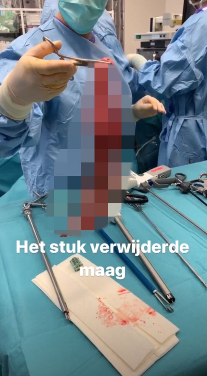 Het stuk maag dat is verwijderd
