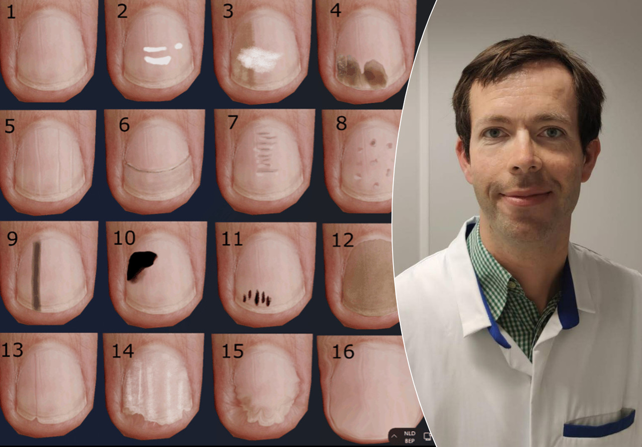 Ce que les taches et fissures sur vos ongles révèlent de votre santé Foto 7sur7.be
