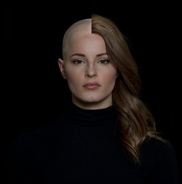 in verlegenheid gebracht Kano Pathologisch Djenzie (20) heeft een haarziekte en doet mee aan een missverkiezing: 'Ik  wil laten zien dat je ook met een kaal hoofd mooi kunt zijn' | West Betuwe  | gelderlander.nl