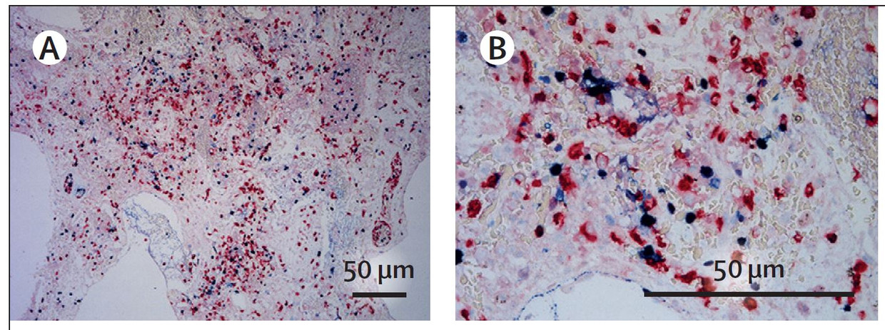 Microscoopfoto van het weefsel van een coronapatiënt, met slierten eiwit en dna, uitgeworpen door afweercellen. Beeld The Lancet