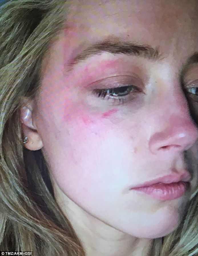 TMZ publiceert deze foto van Amber Heard, die ze binnenbracht bij de rechtbank. Daarop is te zien hoe erg ze eraan toe was nadat Depp een gsm naar haar gezicht gooide.