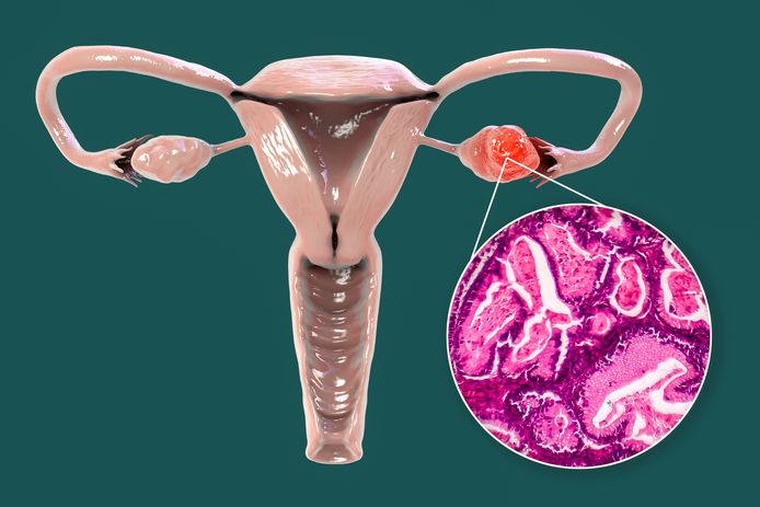 De verbanden tussen PFAS en eierstok- en baarmoederkanker werden door de onderzoekers in de VS vooral gezien bij witte vrouwen.
