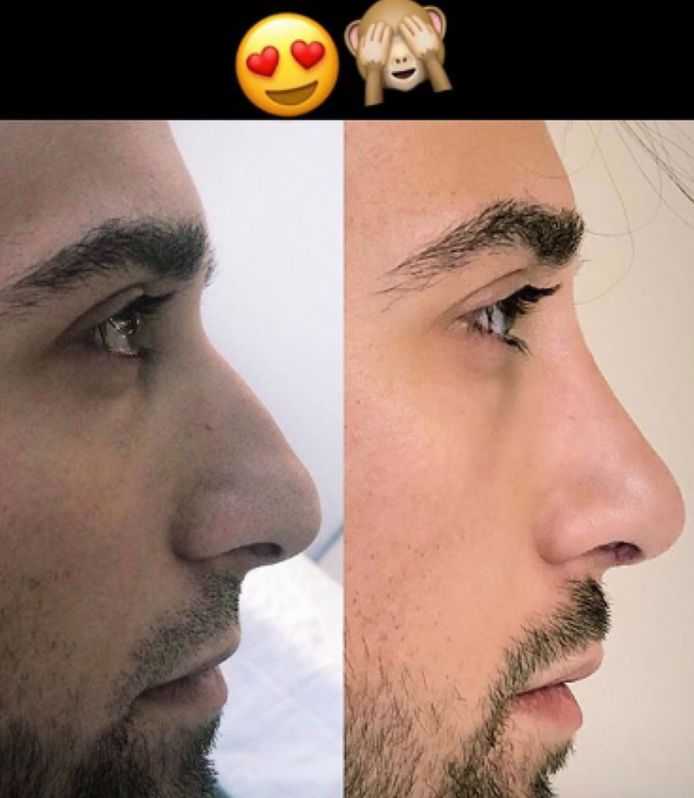 Fabrizio met nieuwe neus
