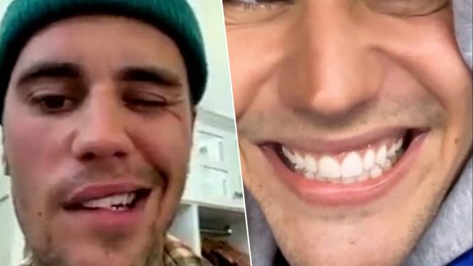 KIJK. Ondanks gezichtsverlamming: Justin Bieber kan weer lachen