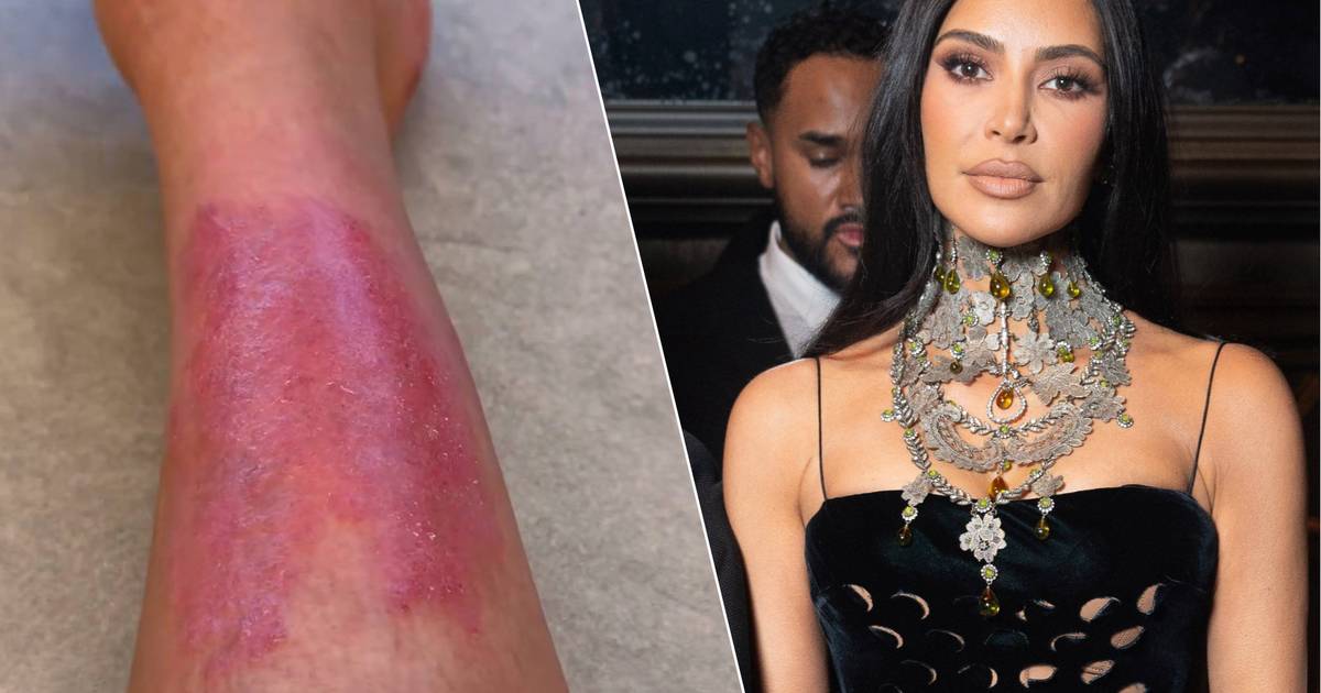 Kim Kardashian rivela la dolorosa verità sul peggioramento della psoriasi: “Non so cosa sta succedendo” |  celebrità