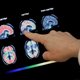 Medicijn vertraagt achteruitgang door alzheimer