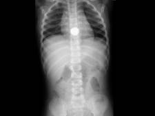 Nieuwe Leidraad Voor Kinderen Die Levensgevaarlijke Batterijen Inslikken Dit Is Zo Ontzettend Te Voorkomen Rotterdam Ad Nl