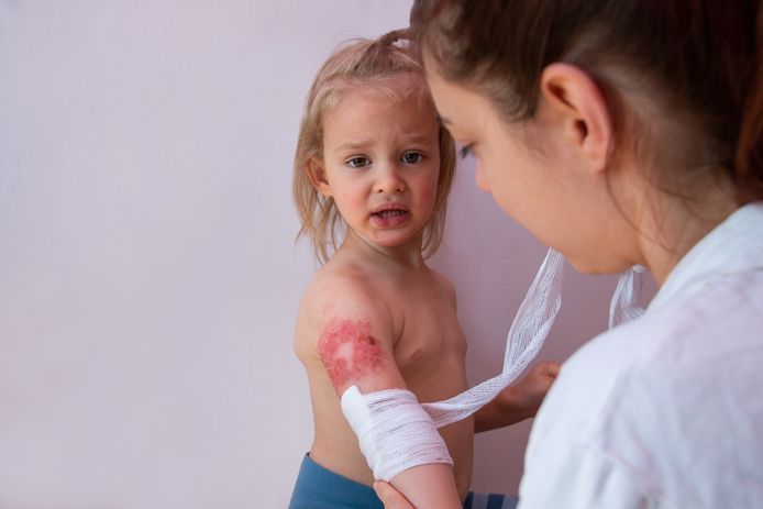 Vaak worden kinderen getroffen door een steekvlam nadat iemand een vloeibare brandversneller gebruikte. (Illustratiefoto)