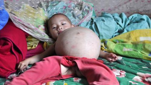 Un Bebe Chinois Nait Avec Son Jumeau Dans Le Ventre Famille 7sur7 Be