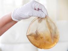 Vrouwen eisen 600 miljoen van maker ‘gevaarlijke’ borstimplantaten: ‘Ze lekken allemaal’