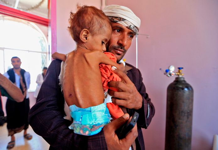 Een man brengt zijn ondervoede kindje naar het ziekenhuis in de Jemense hoofdstad Sanaa.