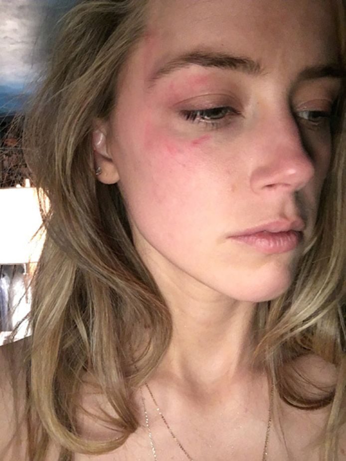 Amber Heard toont haar verwonding.