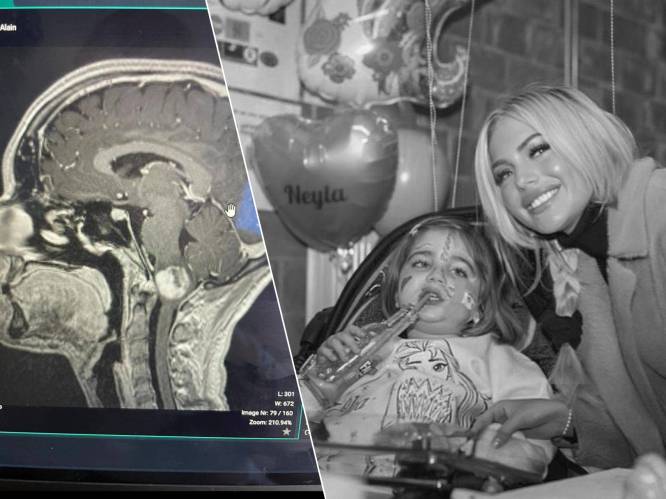 Tumor van Amalie (26) lijkt op degene die Neyla (5) het leven kostte: “Tijdens mijn operatie ben ik er twee keer bijna in gebleven”