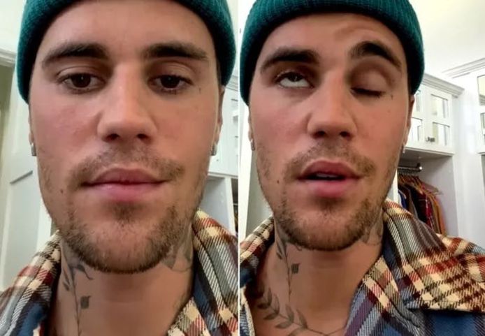 Gezicht van Justin Bieber deels verlamd door virus