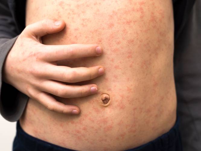 Mazeleninfecties in het Verenigd Koninkrijk stijgen aan alarmerend tempo: experts maken zich zorgen