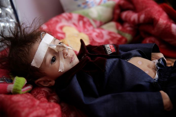 Un enfant souffrant de malnutrition au Yémen (novembre 2019)