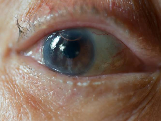 Drie patiënten UZ Leuven permanent blind aan één oog na routineoperatie