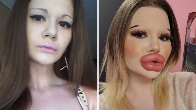 Cette influenceuse bulgare veut se transformer en poupée Bratz: après une trentaine d'injections aux lèvres, elle s’attaque à ses pommettes