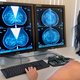 Genetische screening van erfelijke kankers redt levens