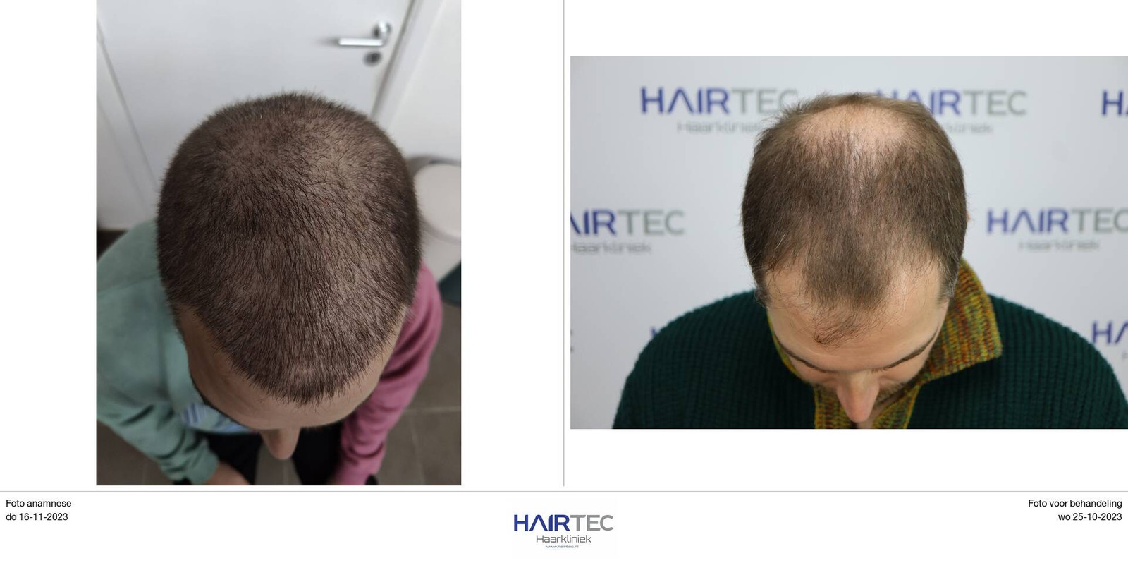 “Pas na 6 maanden ken ik het resultaat” Tom Dice onderging haartransplantatie in Delft Foto