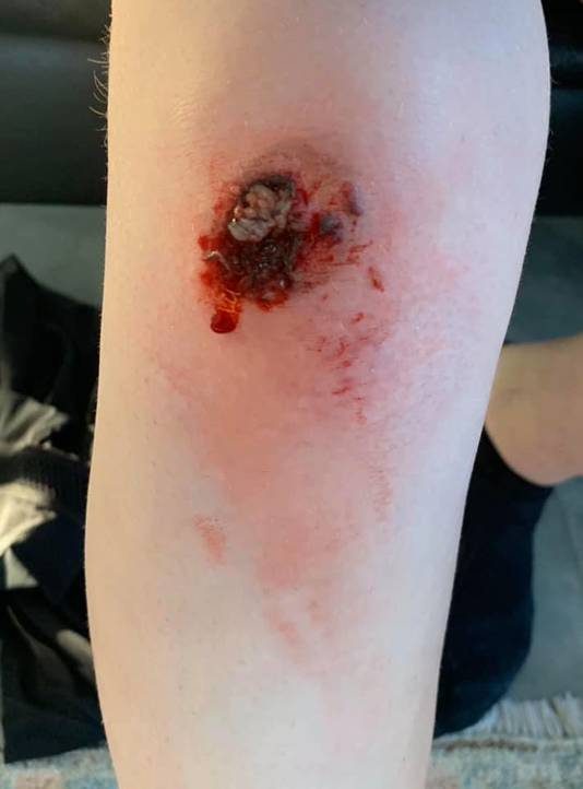 Het slachtoffer liep onder andere een diepe wond in haar knie op.