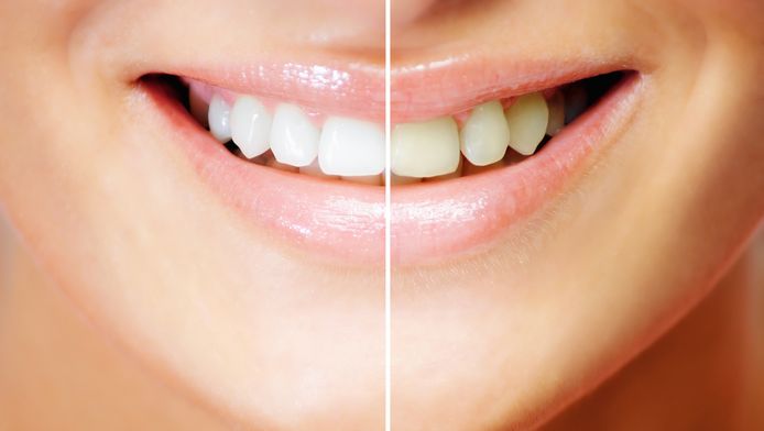 Inschrijven Zin Afwijking Zelf natuurlijk je tanden bleken, een goed idee? | Fit & Gezond | hln.be