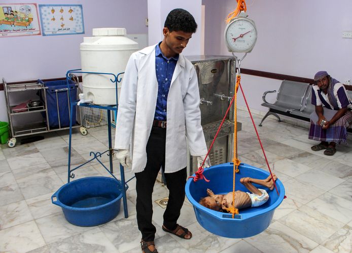 Een ernstig ondervoed kind wordt gewogen in een ziekenhuis in de noordwestelijke provincie Hajjah op 19 september 2018. 5,2 miljoen kinderen riskeren volgens de ngo Save the Children de hongerdood.