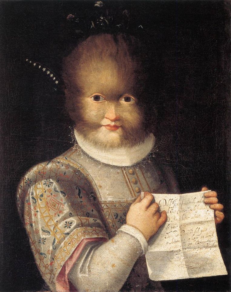 Lavinia Fontana portretteerde Antonietta Gonzalez, een meisje met ‘weerwolfsyndroom’. Haar vader was in opdracht van de Franse koning Henry  uit de Canarische eilanden meegenomen naar Frankrijk. De vader en Antonietta’s twee zussen hadden alle het syndroom hypertrichosis. Op het briefje in haar hand staat dat de familie thuis vond rond het hof van Isabella Pallavicina, de markiezin van Soranga, in Parma. 1595, Musée du Château, Blois. Beeld Alamy