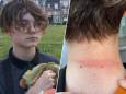 Trans jongen Luca (13) aangevallen na Pride Brussel: “Hij houdt er een brandwonde, blauwe plekken en nachtmerries aan over