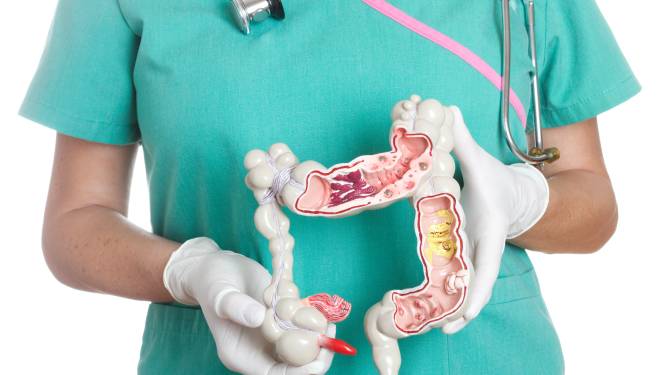 Helft Belgische darmkankers laattijdig ontdekt: "Doe de gratis test. Het is poepsimpel"