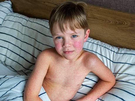 Zorgen bij ouders na eerste geval van mazelen in Zuid-Holland: ‘Kan mijn kind toch ingeënt worden?’