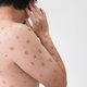 WHO past ‘racistische en stigmatiserende’ benaming apenpokken aan naar mpox